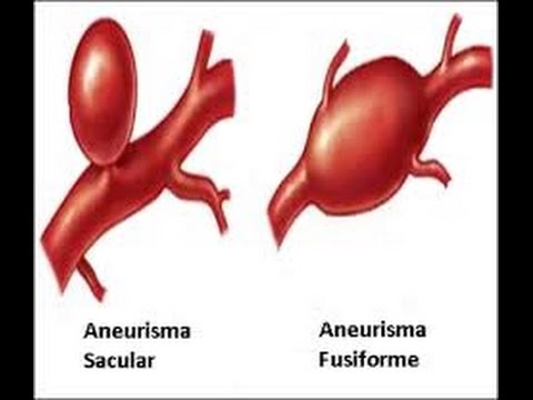 aneurisma