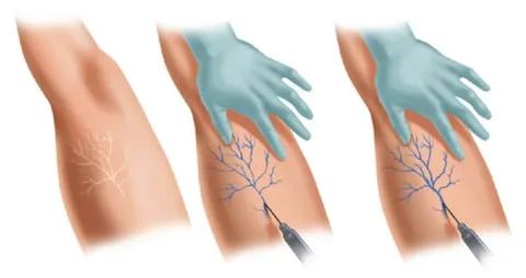 VEIAS